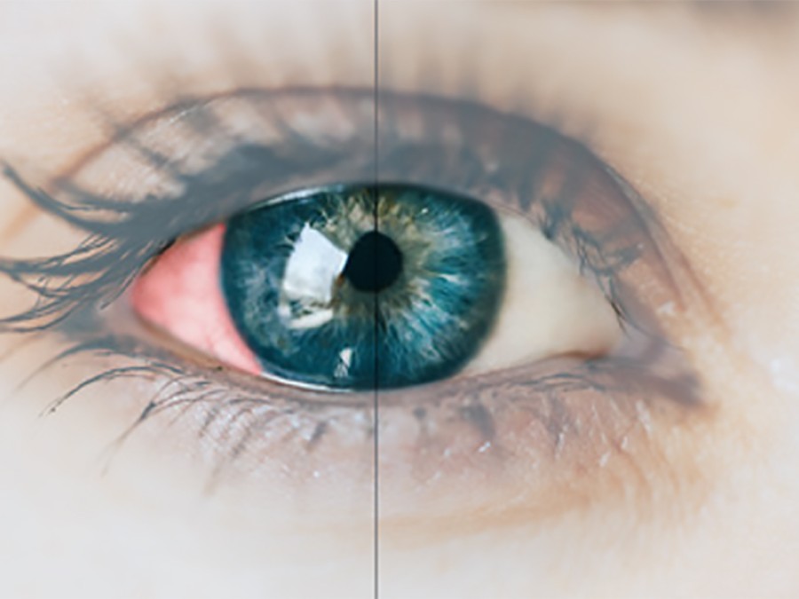 Diabetes y enfermedad ocular: causas, síntomas, diagnóstico y tratamiento